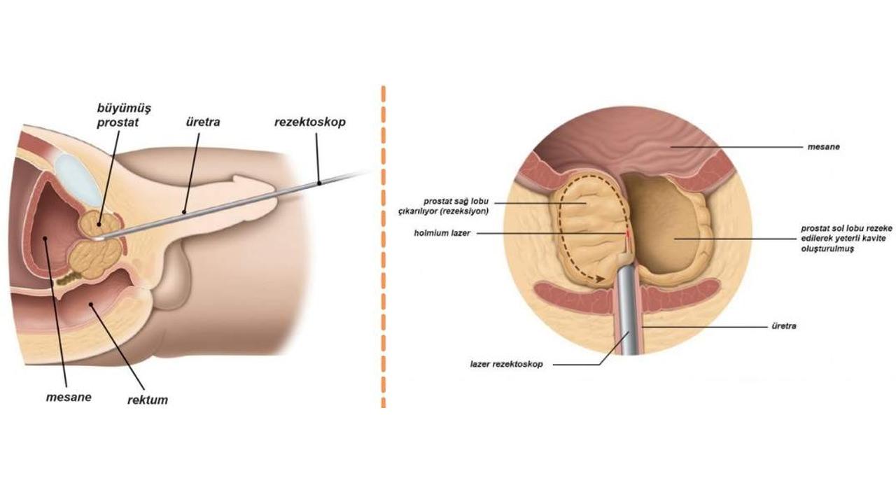 Prostat Hastalığında bir devrim! HoLEP ameliyatı nasıl yapılır?