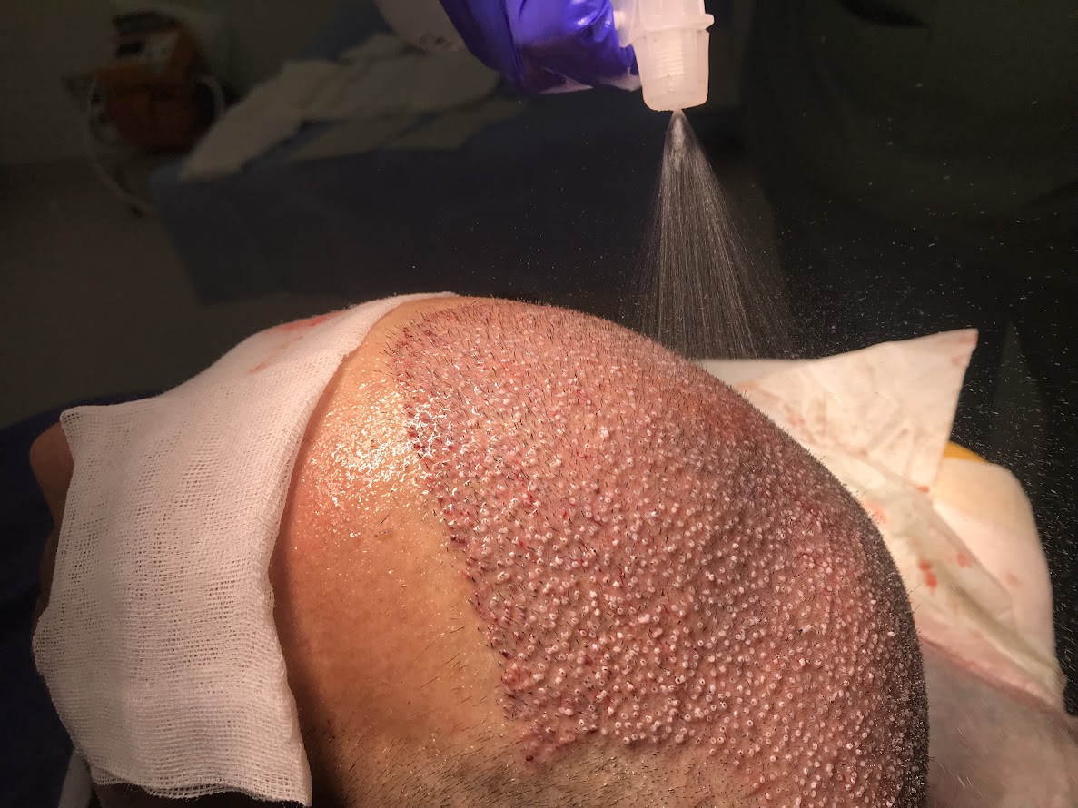 Clinista Saç Ekim Merkezi: En Son Teknoloji ile Saç Ekimi